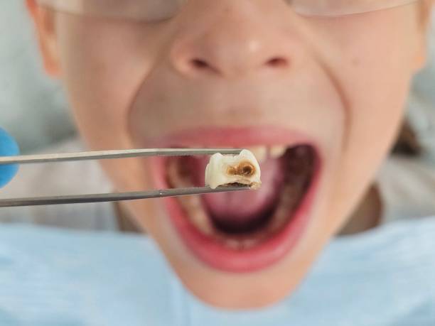 Best Emergency Treatment for Oral Infections in Cornwall On Hudson, NY